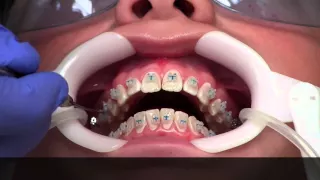 Getting Braces - How?