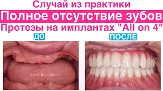 Протезирование зубов на имплантах All on 4, полное отсутствие зубов. Протезирование методом All on 4