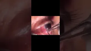 Parasitic worm removal from the eye 👁️