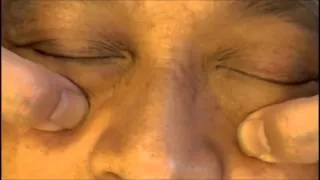 張孟超醫師-眼睛保健穴位(內上睛明，承泣，迎香，翳風，太陽，通天，頭部眼反射區)
