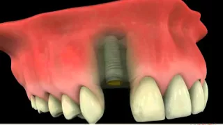 Dental Implant vs Dental Bridge Budapest