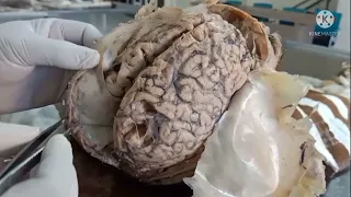 DURAL FOLDS AND DURAL VENOUS SINUSES DISSECTION by Dr BENJAMIN WINCENT