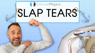 Superior Labral Anterior Posterior Tears | Everything you need to know about SLAP tears!