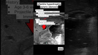 Infantile hypertrophic pyloric stenosis