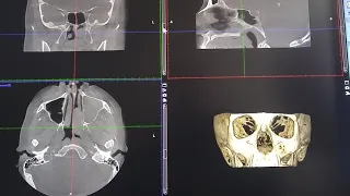 Компьютерная томография как метод диагностики ЛОР заболеваний