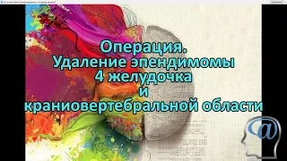 Операция. Удаление опухоли (эпендимомы) 4 желудочка и краниовертебральной области. Нейрохирургия