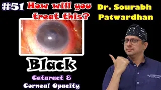 com 51 Black cataract, Severe dry eye, corneal opacity- SICS  Dr Sourabh Patwardhan