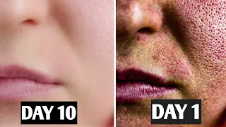 3 Days and All Open Pores Will Disappear from Your Skin Forever| Open Pores Treatment|Open Pores