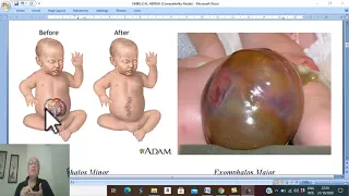 Hernia in Arabic 18 ( Congenital umbilical hernia  ) , by Dr. Wahdan
