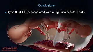 Prediction of fetal death in monochorionic twin pregnancies