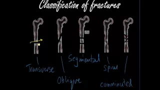 Classifying and presenting Fractures - Orthopaedics for Medical Students / Finals