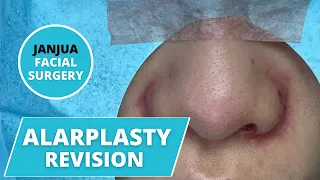 ALARPLASTY REVISION ON ASIAN FEMALE - DR. TANVEER JANJUA - NEW JERSEY