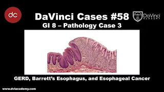 GERD, Barrett's Esophagus, and Esophageal Cancer [#DaVinciCases GI 8 - Pathology Case 3]