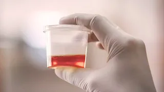 Blood in the Urine (Hematuria) Causes