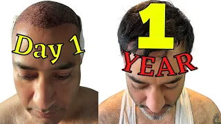 INCREDIBLE RESULTS 1 year FUE Hair Transplant From Turkey before & after