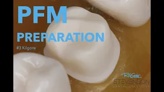 PFM Preparation on The Maxillary First Molar for #3 Kilgore | Stevenson Dental Solutions