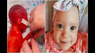 Baby Born So Premature Her Brain Was Visible Through Her Skin Beats Odds To Survive