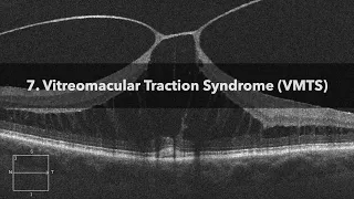 7. Vitreomacular Traction Syndrome (VMTS)