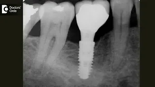 How many teeth can Dental Implants replace? - Dr. Arundati Krishnaraj