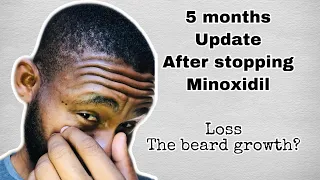 Do you lose your  beard after stopping minoxidil? |5 months after minoxidil