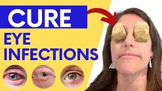 How to Treat Eye Infections, Eye Allergies and Pink Eye Naturally at Home