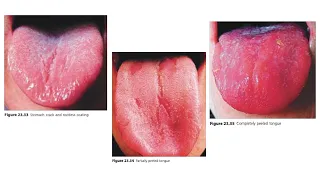 WHAT YOUR TONGUE COATING SIGNIFIES
