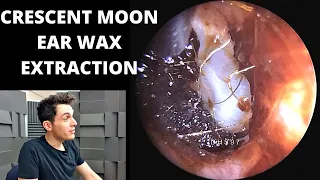 Crescent Moon Ear Wax Extraction