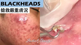 搶救嚴重膚況( blackheads ) - Taiwan Tainan台南清粉刺最乾淨