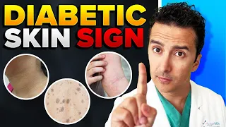 What Has Your Skin Been Trying to Tell You About Your Diabetes!