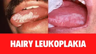 WHAT IS HAIRY LEUKOPLAKIA?: Oral Hairy Leukoplakia Symptoms: Causes: Diagnosis: Treatment