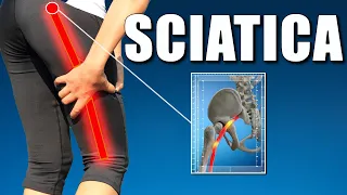 Sciatica (Pain Relief Exercises l Causes & Symptoms l Physical Therapy)