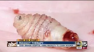 Medical maggots used in Valley hospital
