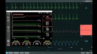 HPI case study 1 - clinical utility of dP dt