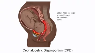 Cephalopelvic Disproportion CPD and Birth Injury