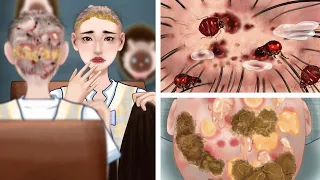 ASMR｜Treatment of abscesses on the head of bald women｜Head lice removal animation｜대머리 소녀를위한 농양 치료