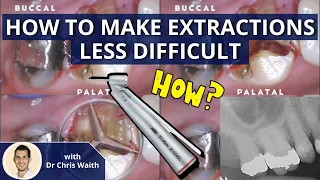 Make Extractions Less Difficult: Sectioning and Elevating Teeth PDP085