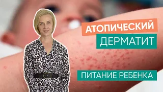 Атопический дерматит и питание ребенка