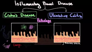 Inflammatory bowel disease: Epidemiology & pathology | NCLEX-RN | Khan Academy