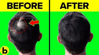 10 PROVEN Tips To RE-GROW Hair FAST - 🚫 WITHOUT Surgery!