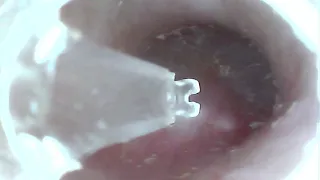 Satisfying Dead Skin Ear Drum Peel Ear Wax