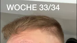 8 MONATE NACH DER HAARTRANSPLANTATION/ ERGBNIS