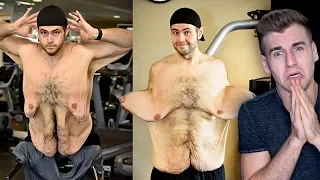 Meet The Man Who Has Uncontrollable Amount Of Loose Skin