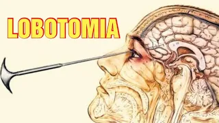 LOBOTOMIA - CONHEÇA A HISTÓRIA DESTE PROCEDIMENTO MACABRO