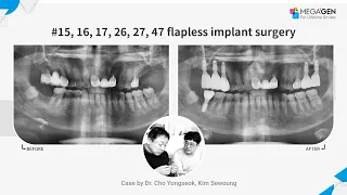 Dr. Yongseok CHO, Sewoung KIM, #15, 16, 17, 26, 27, 47 flapless implant surgery and prosthesis