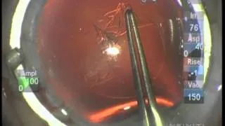 Soft Shell in Cataract Surgery