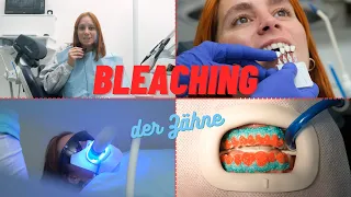 ZÄHNE AUFHELLEN | Ihr erfahrener Zahnarzt berichtet über das ZAHNBLEACHING