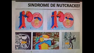 SINDROME DE CASCANUECES-NUTCRAKER TESTIMONIO