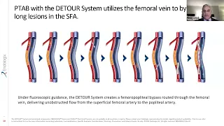 Integrating the Novel PTAB therapy with the DETOUR™ System Into your PAD Practice - MM2801-US Rev 01