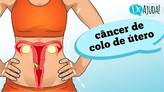 Quais os sintomas do CÂNCER DE COLO DE ÚTERO?