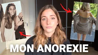 ANOREXIE : MON HISTOIRE